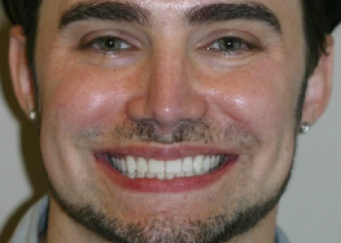 Chad smiling before cosmetic jaw surgery